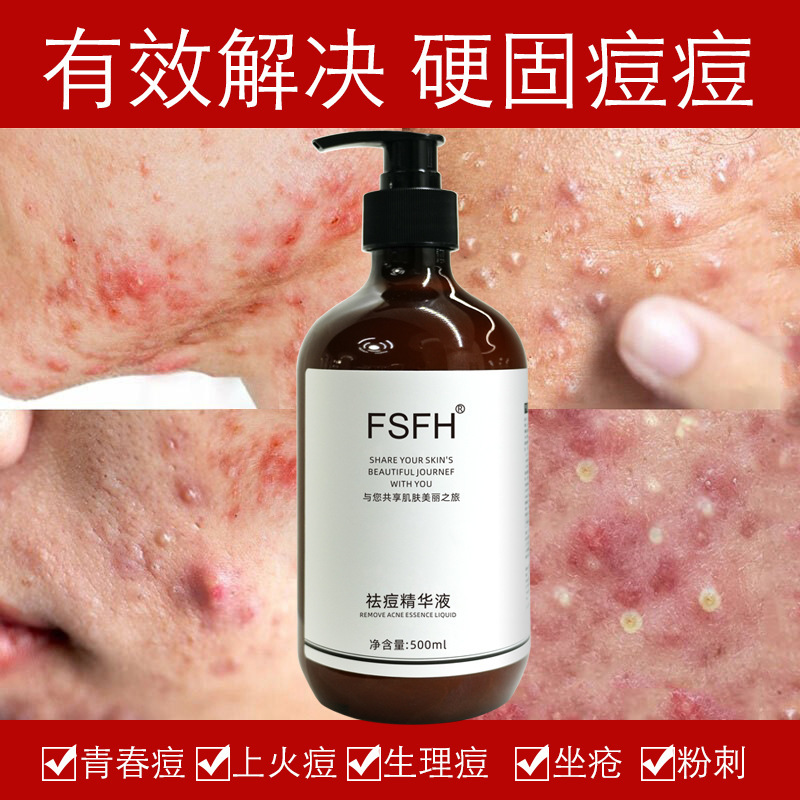 院线装祛痘精华液深层清洁毛孔抑制痘痘再生平衡水油还你光滑美肌|undefined