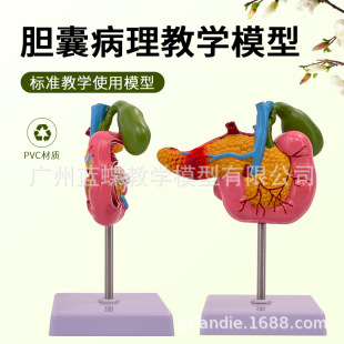 医学胰腺十二指肠胆囊病理模型 胆结石外科消化科系统肝胆科模型-阿里巴巴