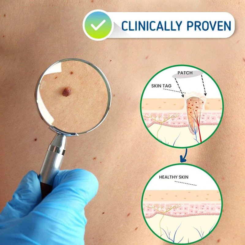 Stift für IBeaLee zum Entfernen flacher, besonders scharfer Warzen, Entfernerflüssigkeit, Creme und Warzenausgleichsflüssigkeit_voghion.com