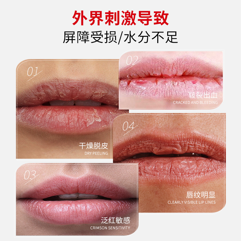 漢方薬唇炎治療用冷却ジェル、皮むけ、発疹、唇の乾燥、水分不足、保湿クリーム、修復|undefined