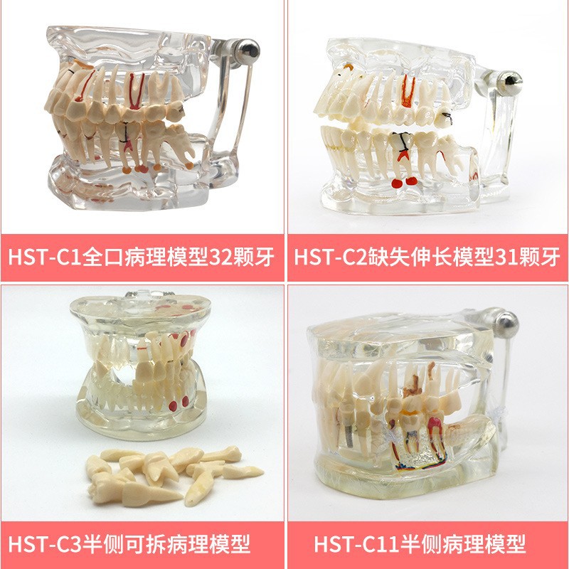 牙齒模型牙模型醫患溝通模型綜合病理模型可拆卸牙模口腔教學模型