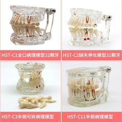 牙齒模型牙模型醫患溝通模型綜合病理模型可拆卸牙模口腔教學模型