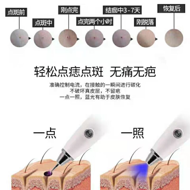 顔用ほくろ除去ペン、プラズマスポット掃除レーザー、無痛赤青光ほくろ除去ツール、スキンケアとそばかす除去|undefined
