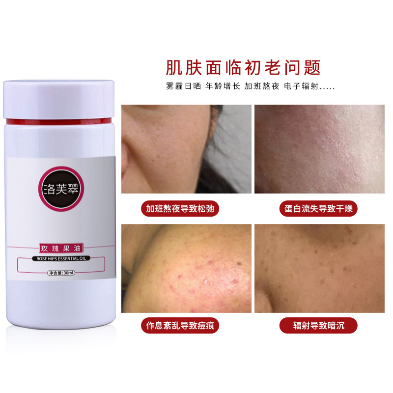 玫瑰果油提拉紧致抵御初老亮皙脸部嫩肤淡化细纹刮痧按摩油基础油|undefined