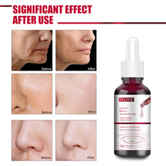 AHA30% + BHA 2%果酸水楊酸精華去角質閉口黑頭粉刺收縮毛孔精華