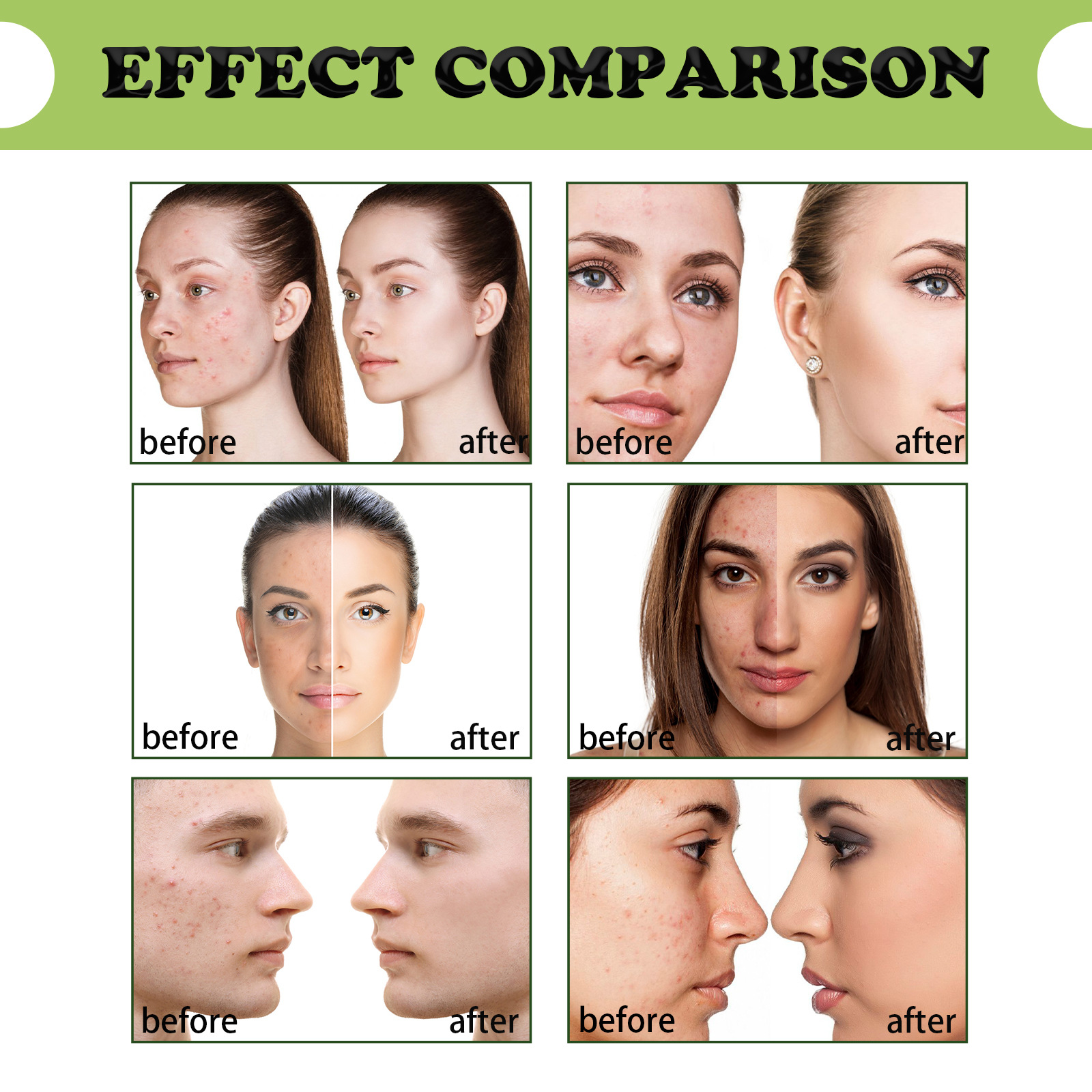 EELHOE Tea Tree Repair Lightens Marks, Cleans Acne, Removes Acne and Repairs Skin essence_voghion.com