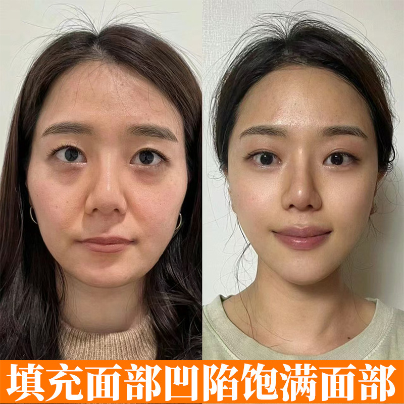 コラーゲン充填クリームシワ除去クリーム保湿抗シワ肌クリームコラーゲン再構築クリーム|undefined
