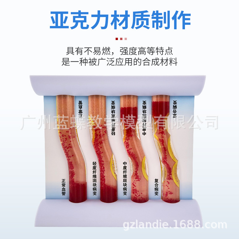 Ѫ�ܷ������Ѫ֬��Ѫ֬ģ�Ͳ�����̬Ӳ������Ѫ˨ֱ�۽�ѧ����