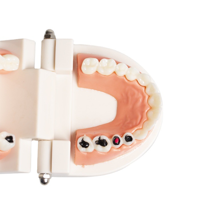 Modelo de caries dental para niños, modelo de cuidado de la enseñanza del cepillado de dientes de jardín de infantes, modelo de patología dental de la enseñanza oral