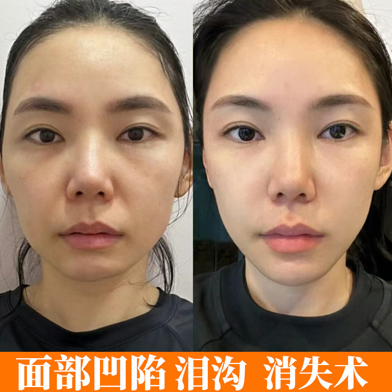 面部丰盈精华原液去凹陷面脸部饱满填充胶原蛋白三类重组抗皱紧致