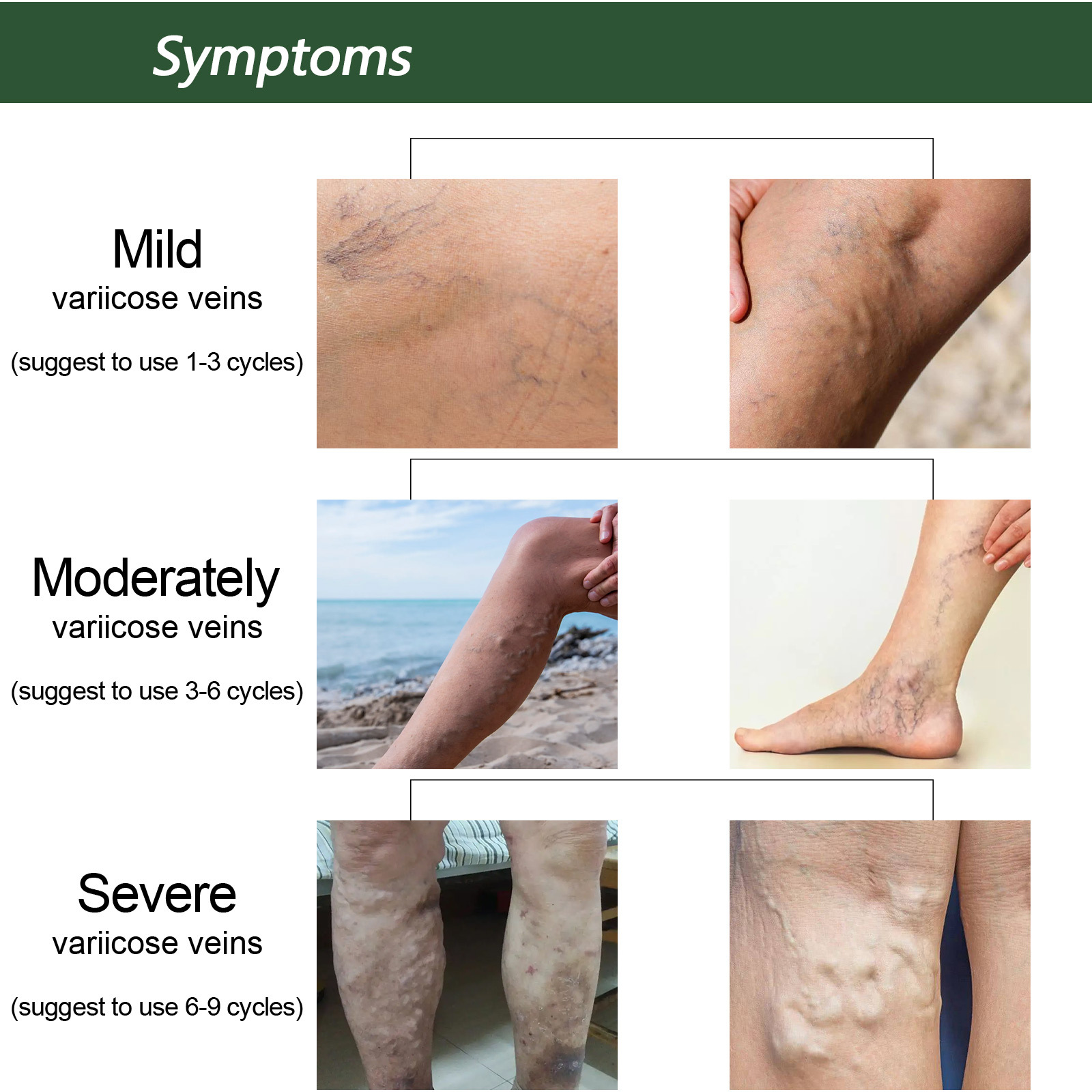 Massaggio endovenoso Eelhoe con sapone per lenire le varici, alleviare le sporgenze nelle gambe dei lombrichi e pulire il polso_voghion.com