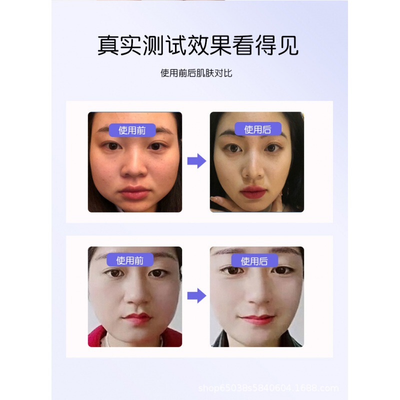 ST筋膜リフティング 三線リフティング ほうれい線 顔の小じわ 顔の液体糸彫り 9Dリフティング 小顔Vフェイス|undefined