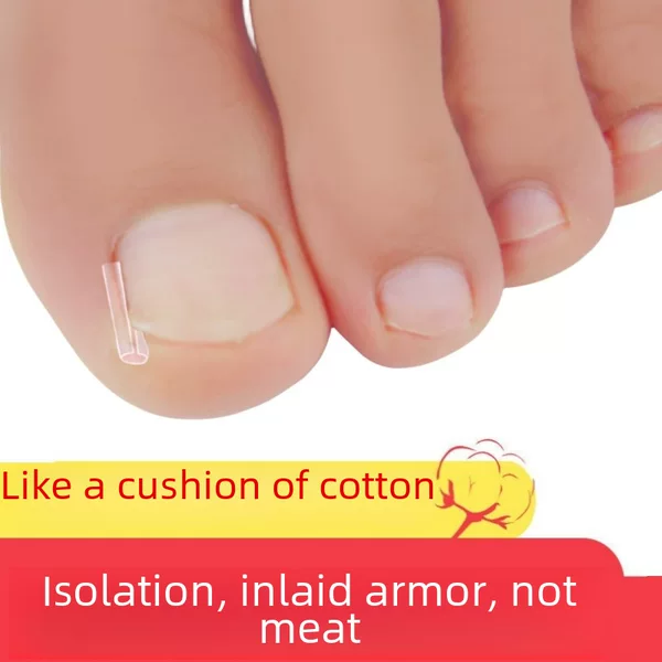 Indrown nail type C pad nail groove ingrown nail inflammation filling spacer straightener nail paste nail toenail long meat