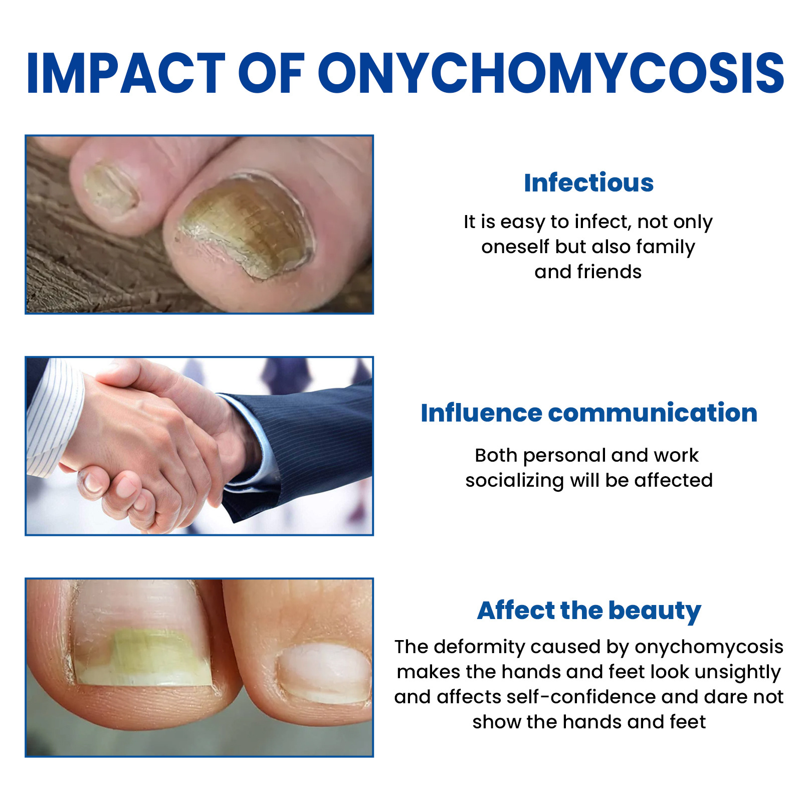 Ximonth 爪修復パッチ手と足の柔らかい爪陥入爪肥厚明るい爪爪溝爪真菌症ケアパッチ