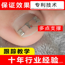 正甲丝 嵌甲矫正器多点固定支撑正甲扣单丝