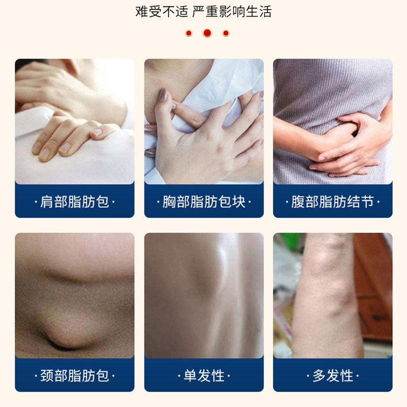 川井弘岩脂肪康消散膏 胸部脂肪包块腹部脂肪结节不适外用护理膏|undefined