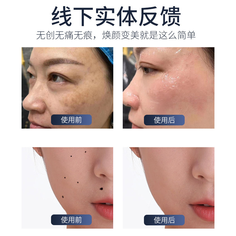 5g磁波吸附去斑扫斑去黑色素无痕秒斑美容院专用美肤祛斑美容仪|undefined