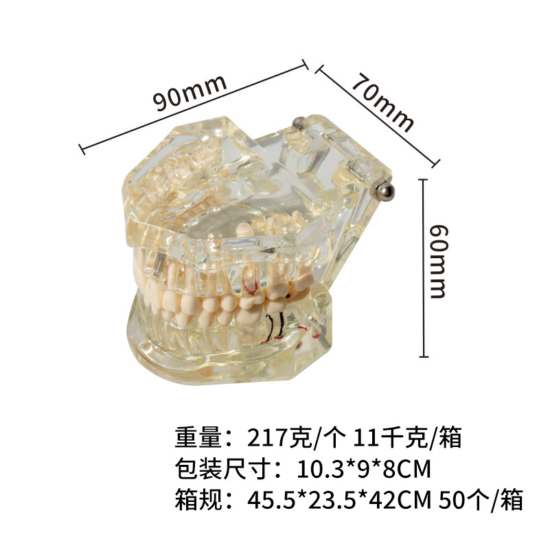 Modelo de implante dental, modelo dental patológico, modelo oral desmontable, modelo de explicación de puente, protección dental