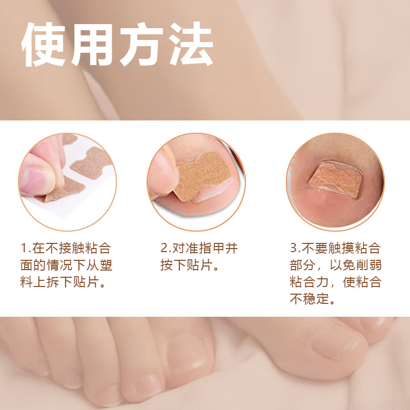 Corrección de uñas artefacto ranura de uñas incrustaciones de uñas corrector de uñas dedo del pie corrección de uñas parche fuente de fábrica