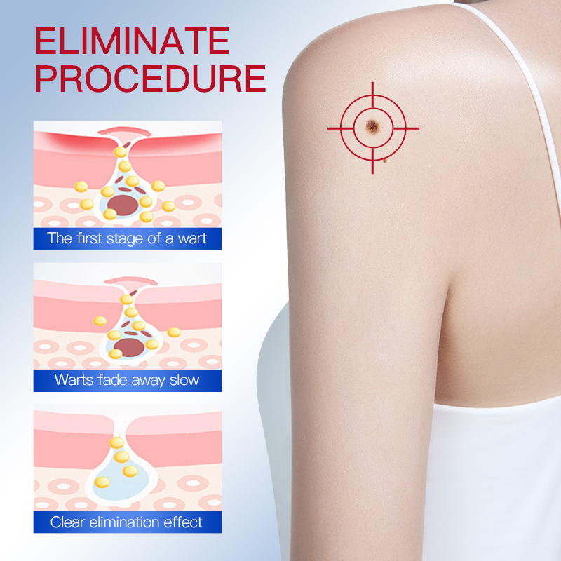 SADOER Warzenflüssigkeit, Maulwurfentfernung, glatte, makellose Haut, Absorptionsessenzstift_voghion.com