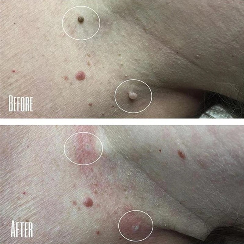 Stift für IBeaLee zum Entfernen flacher, besonders scharfer Warzen, Entfernerflüssigkeit, Creme und Warzenausgleichsflüssigkeit_voghion.com