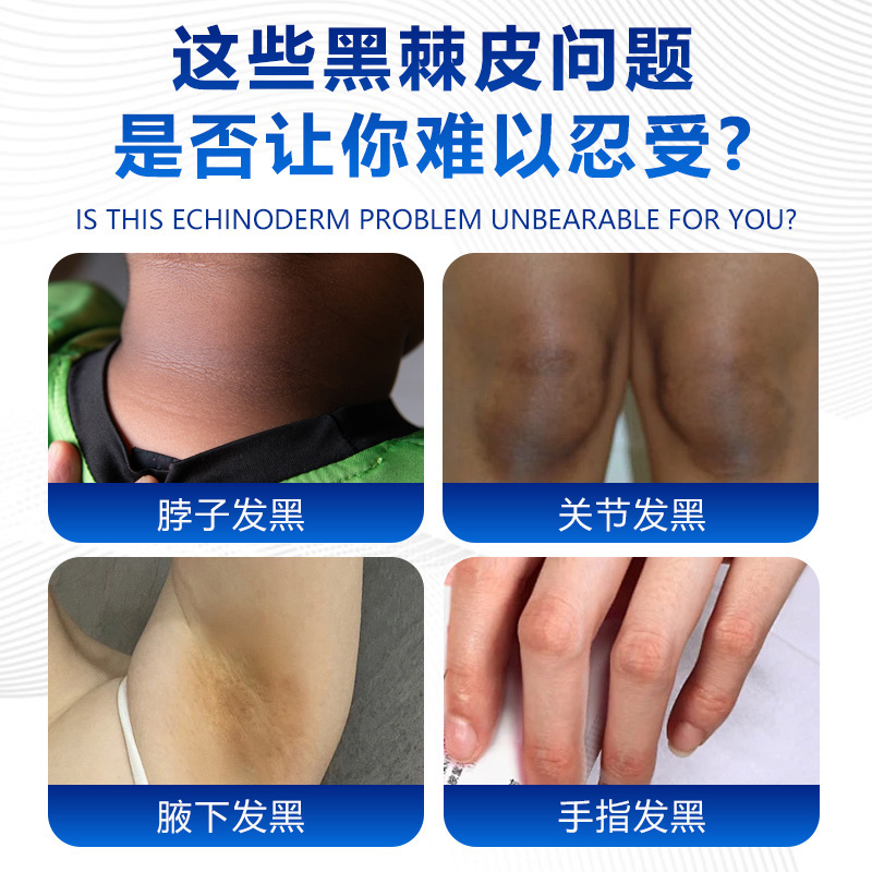 德国弗里亚黑棘皮膏去黑皮肤黑色素沉淀皮肤不适脖子关节发黑暗沉|undefined