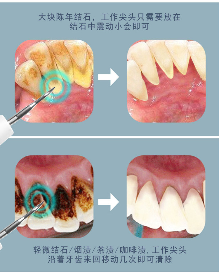 全自动智能洁牙器