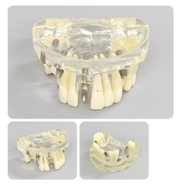 Modelo de ortodoncia dental semi-metal semibrackets Práctica de corrección de molde dental estándar Comunicación médico-paciente Modelo de enseñanza Modelo dental