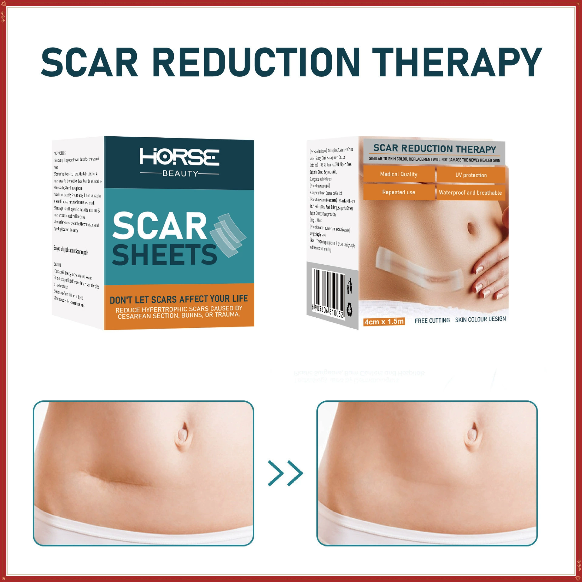 Трансграничный HORSE силиконовый гель со шрамом наклейки Silicone wound repair scar patches