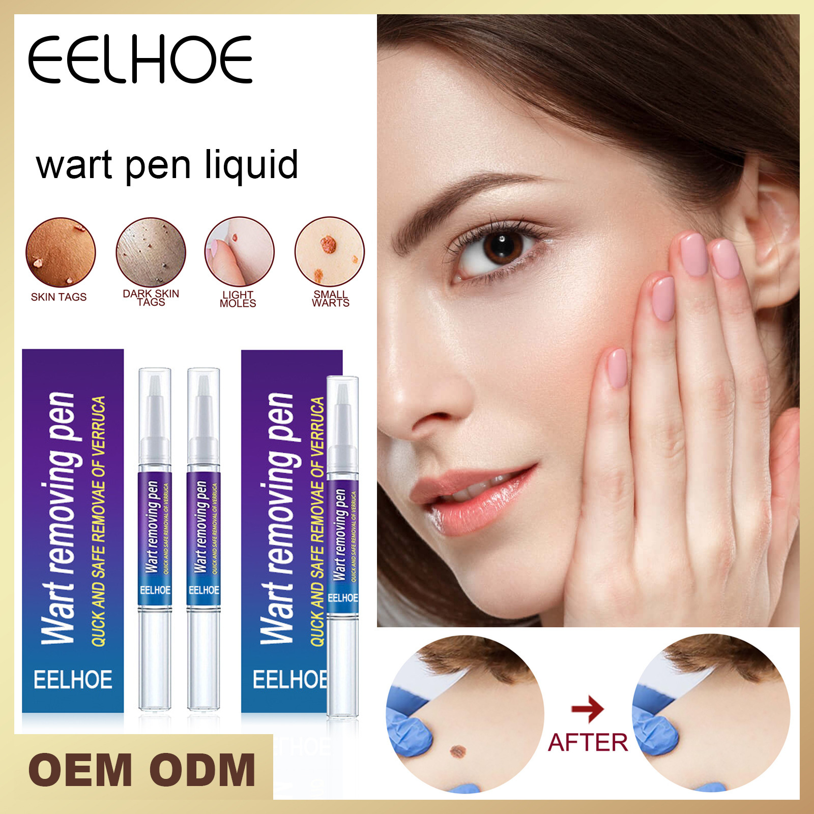 eelhoe wart-removing pen wart-removing wart-removing wart-removing wart-removing flat-sharp wart-piercing chicken-eye wart-removing cream youxiping liquid