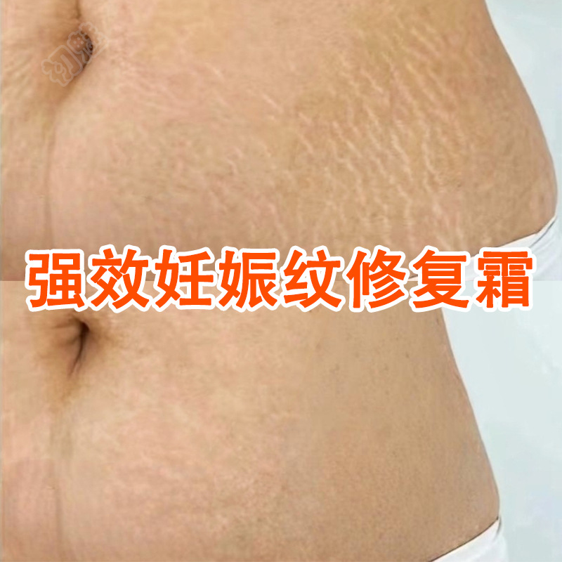 Stretch Mark Repair Cream Removes Postpartum Stretch Marks, Prevents Obesity Marks, Growth Marks, Tightens and Tightens the Abdomen, Stretch Mark Repair Cream