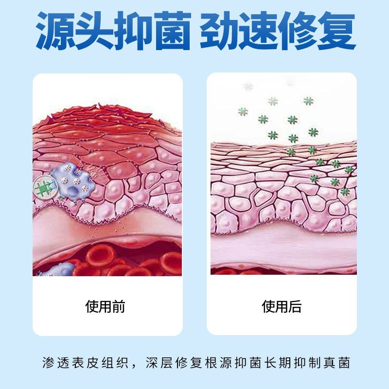 足力康脚部瘙痒草本脚痒脚干脚烂足部护理脚臭脱皮水泡|undefined