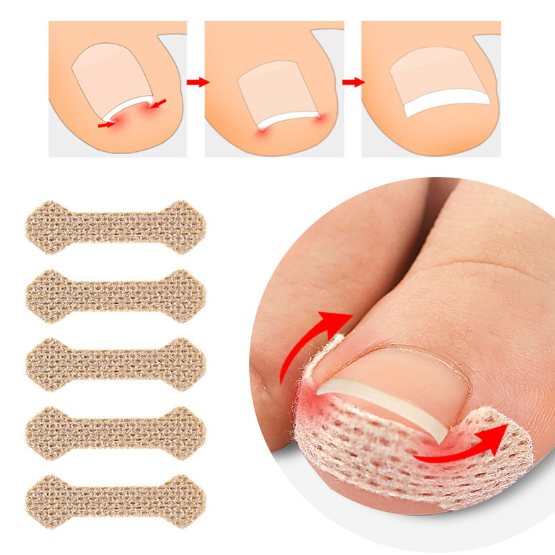 Nail art patch patch to flesh and toe orthosis embedded in nail lala nail patch repair pad foot lie in nail long Guangdong