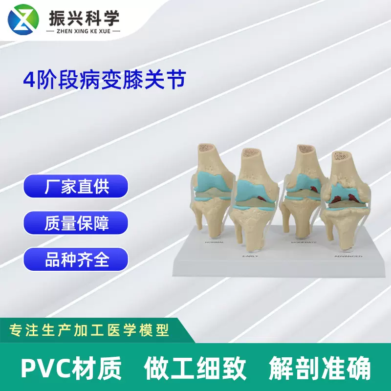 4阶段病变膝关节模型 厂家供应医学教学器材