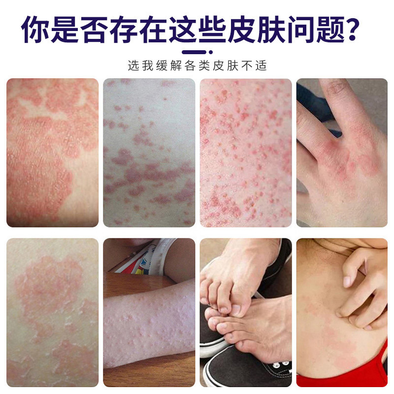 苗薬白癬かゆみ止めハーブかゆみ止めクリームスキンケアクリーム穏やかななだめるハーブエッセンス速効かゆみ止めクリーム|undefined