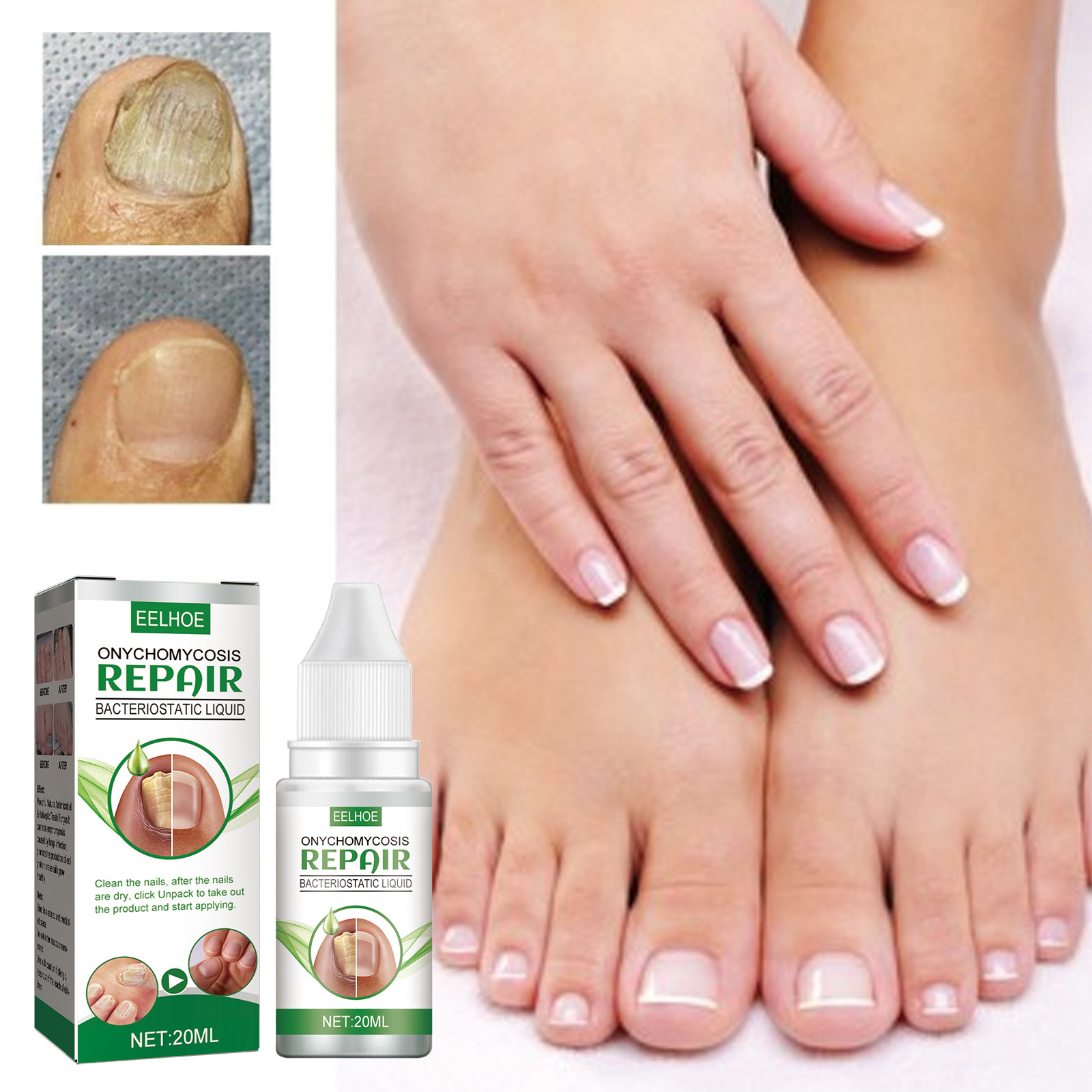 EELHOE Nail Repair Liquid for Nail Fungus Nail Thickening and Discoloration Falling Soft Nail Thickening Type