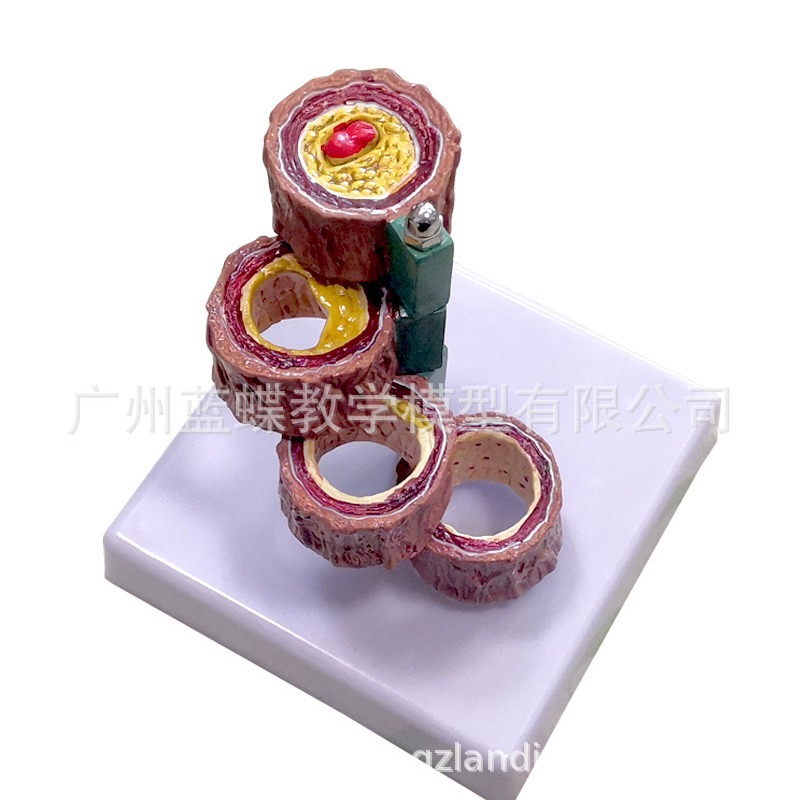 Arteria/aterosclerosis y trombosis/modelo de formación de cuatro etapas modelo de proceso vascular/endurecimiento