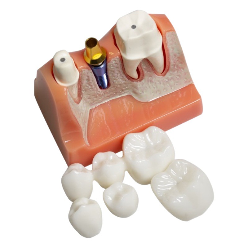 Dental 4 veces modelo de implante dentadura reparación implante interpretación puente desmontable corona modelo de implante