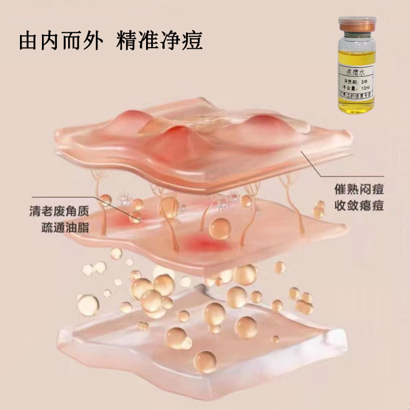 点痘水植物萃取浓缩精华淡化痘印痤疮祛闭口粉刺加速瘪痘一天起效|undefined