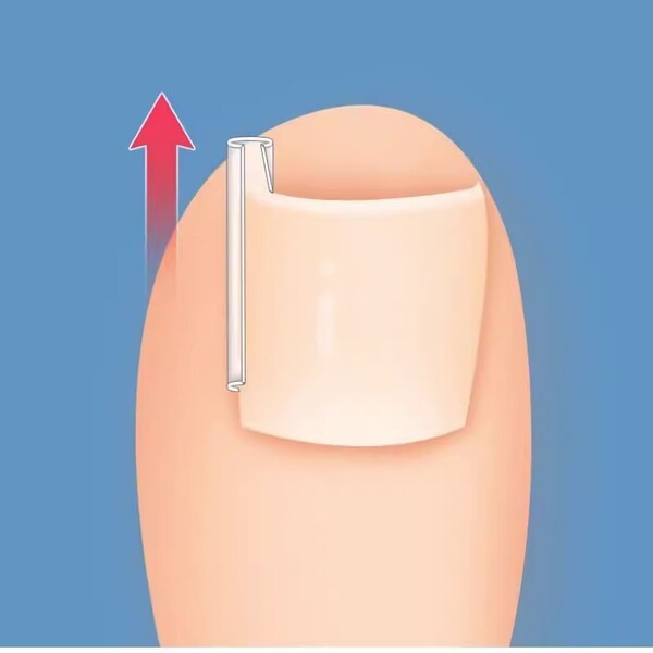 Orthotics for contouring for nails
