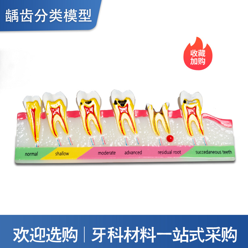 Modelo de clasificación de caries dental Demostración de la evolución de la caries dental Explicación de la comunicación médico-paciente Modelo de enseñanza dental oral