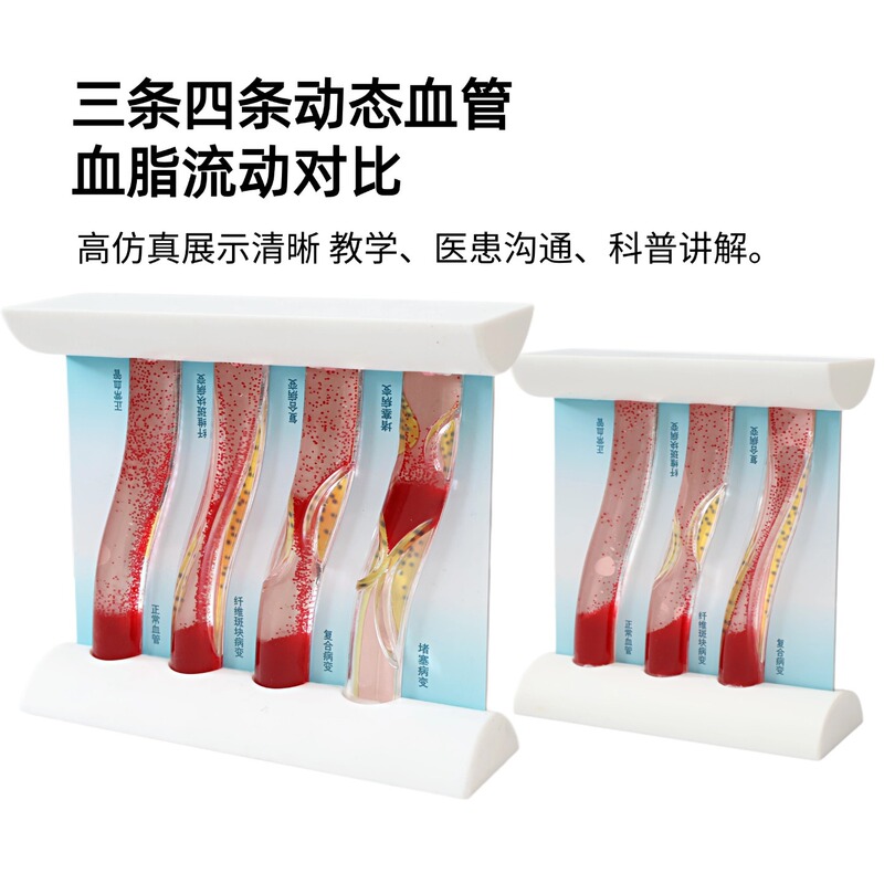 Simulated Dynamic Vascular Model Showing Blood Lipid Concentration, Flow Blockage, Comparison of Plaque and Thrombosis Pathology, Enlarged Educational Tool Simulated Dynamic Vascular Model Showing Blood Lipid Concentration, Flow Blockage, Comparison of Plaque and Thrombosis Pathology, Enlarged Educational Tool