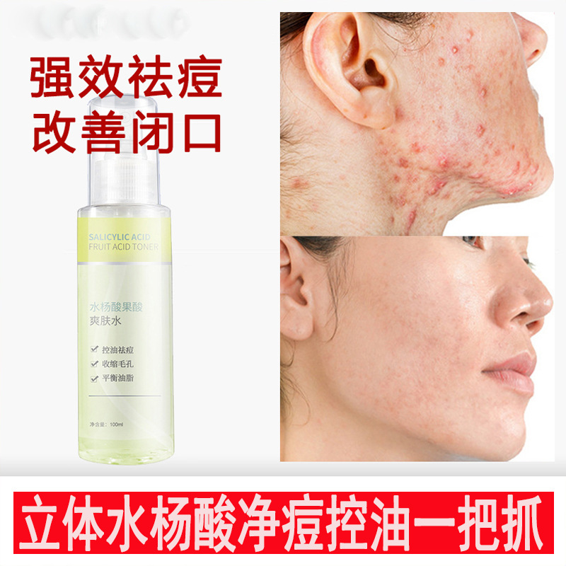 水杨酸爽肤水紧致精华液去闭口粉刺湿敷水祛痘印修复毛孔粗大精华