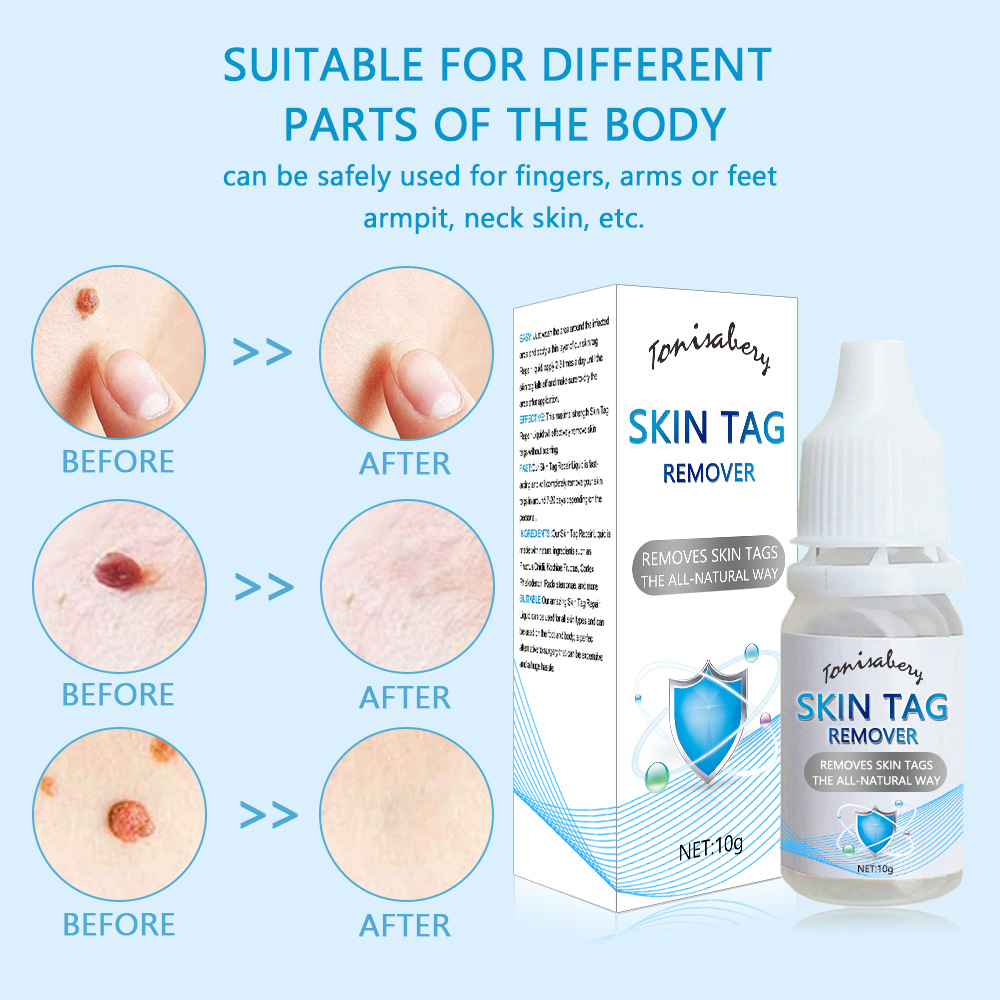 Skin Tag-Reinigungsflüssigkeit zur Wachstumskontrolle, Hühneraugenklappe und Entfernung von Dornwarzen_voghion.com