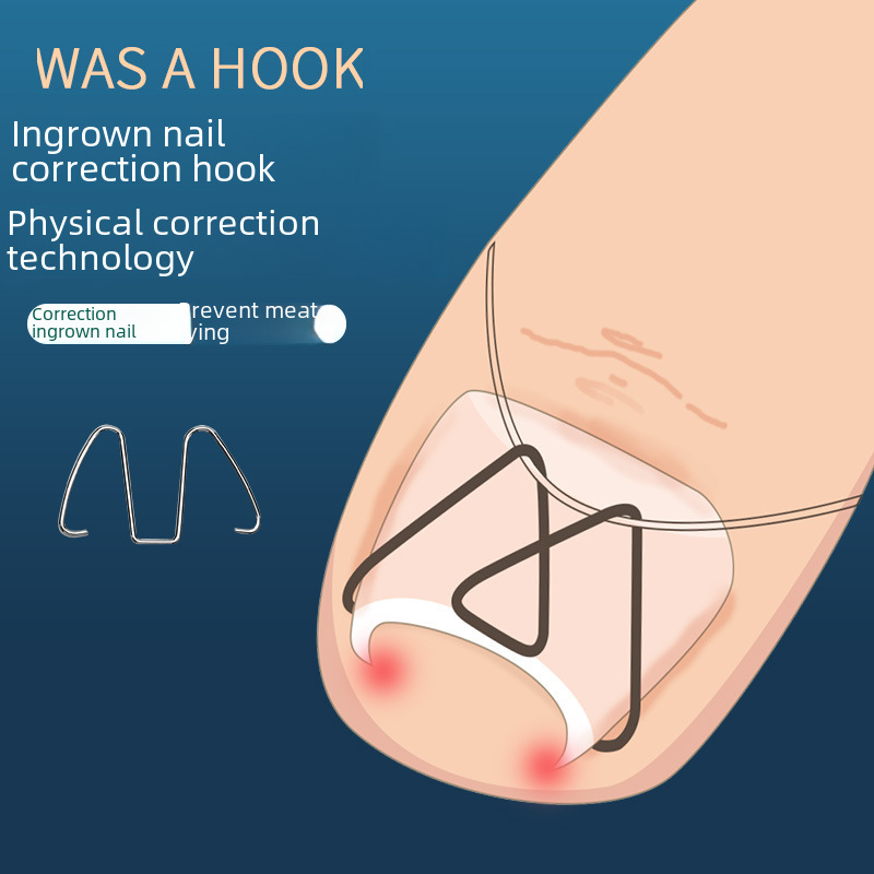 Ingrown Toenail Correction Tool for Correcting Ingrown Nails, Nail Groove Correction, Ingrown Toenail Correction, Toenail Correction Device, Pedicure Tool