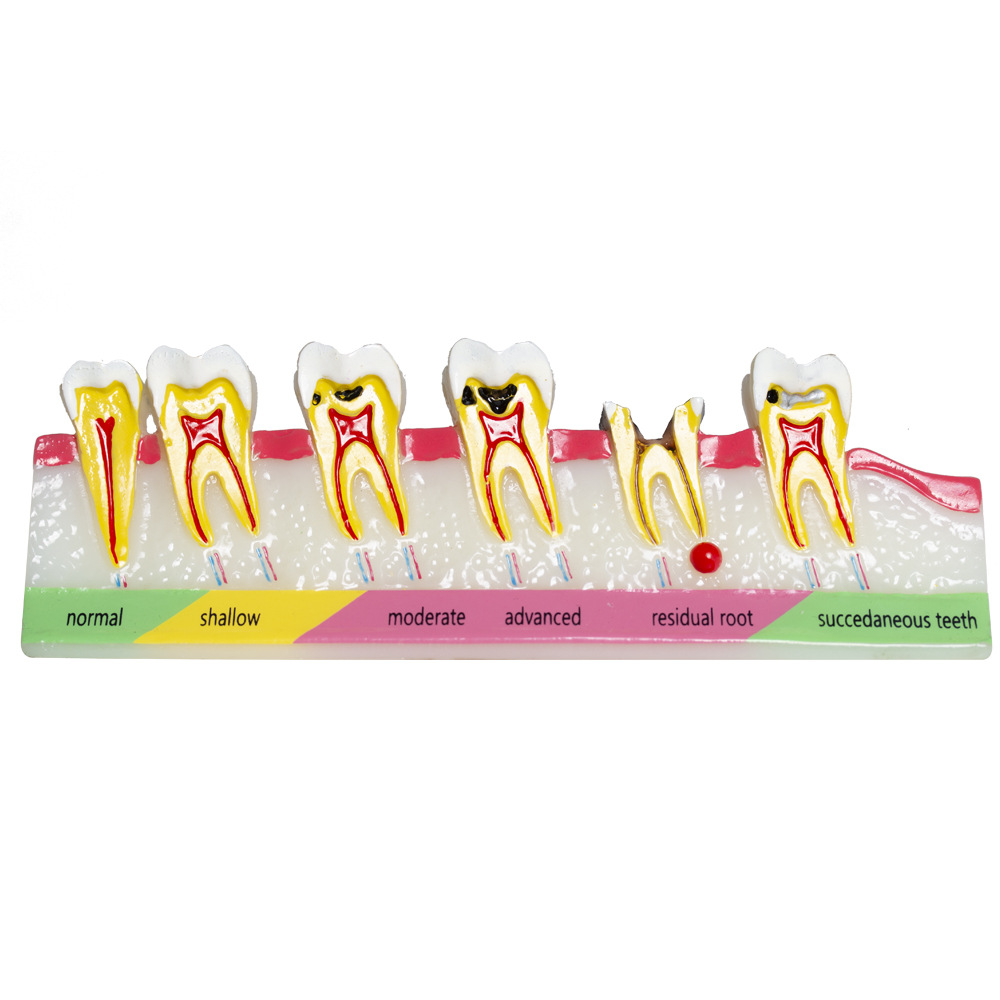 Modelo de clasificación de caries dental Demostración de la evolución de la caries dental Explicación de la comunicación médico-paciente Modelo de enseñanza dental oral