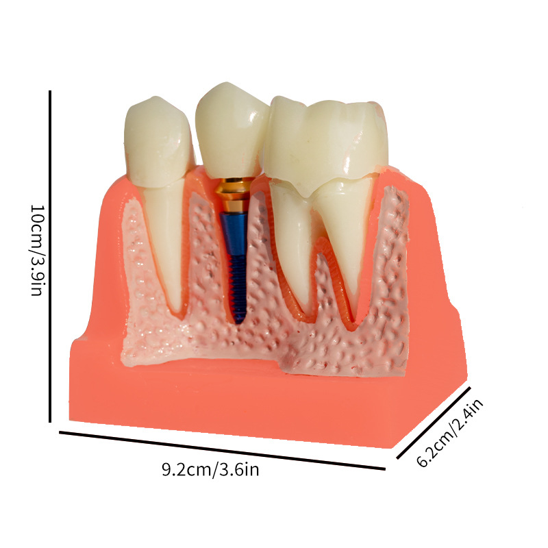 Dental 4 veces modelo de implante dentadura reparación implante interpretación puente desmontable corona modelo de implante