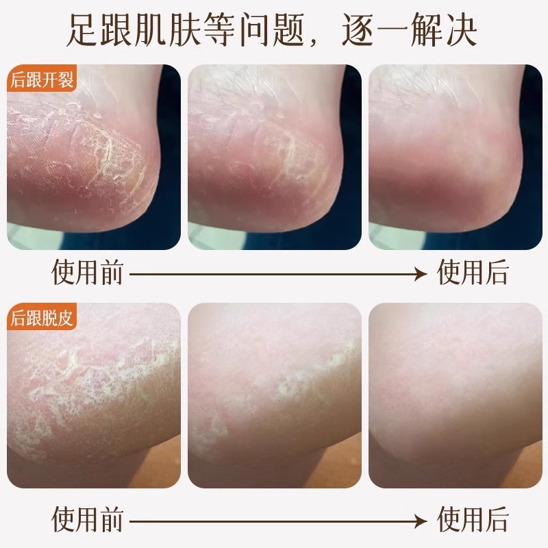 防裂袜子脚后跟干裂男女款春秋季中筒硅胶保湿护脚足跟防皲裂长袜|undefined
