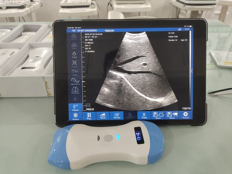 掌上超声  掌上B超 无线超声 无线超wireless ultrasound machine|undefined