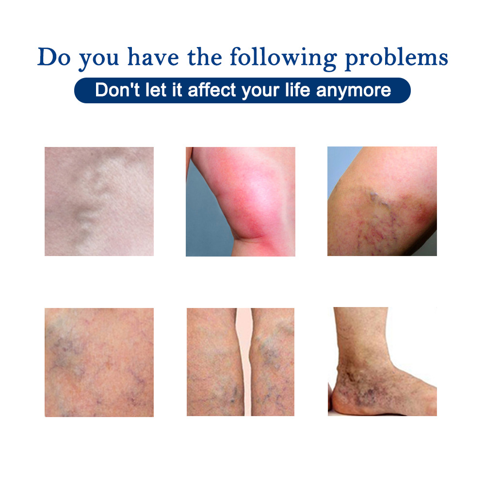 Spezielles 30ml Quzhang Regenwurm Bein-Aktivierungsspray zur intravenösen Massage_voghion.com